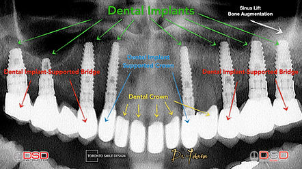 Full Mouth Rehabilitation - Cosmetic Dentist Toronto - Toronto Dental Clinic.jpeg