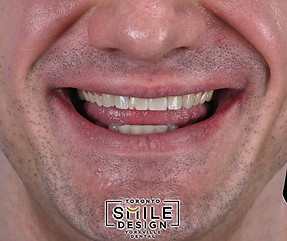Grinding bruxist patient treatment by the best cosmetic dentist in toronto with veneers an