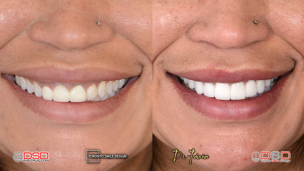 Cosmetic Dentistry Toronto - Smile Desig