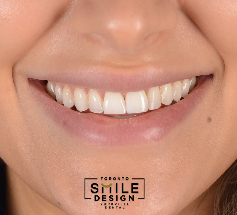 Porcelain Veneer in Toronto - Best Dentist in Toronto