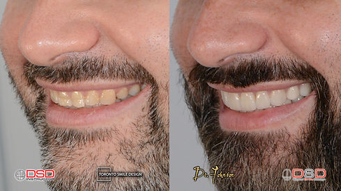 Veneer Toronto - Cosmetic Dentist - Worn out Teeth.jpeg