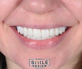 Porcelain Crowns and Dental Veneers in Toronto by the best cosmetic dentist.001.jpeg