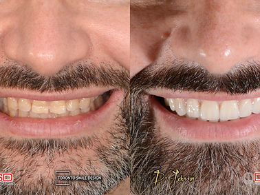 Veneer Toronto - Cosmetic Dentist - Crown Lengthening.jpeg