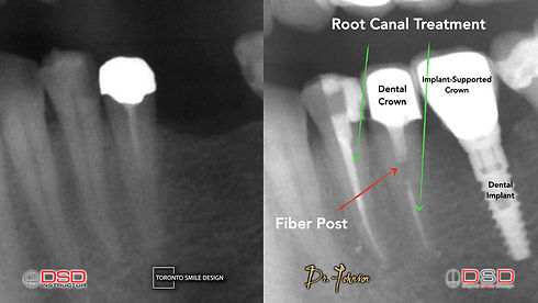 Root Canal Cost - Toronto Root Canal.jpeg