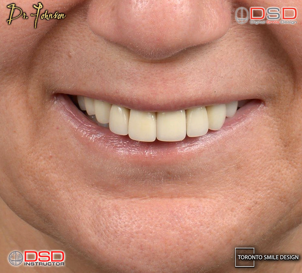 Implant Supported Bridge