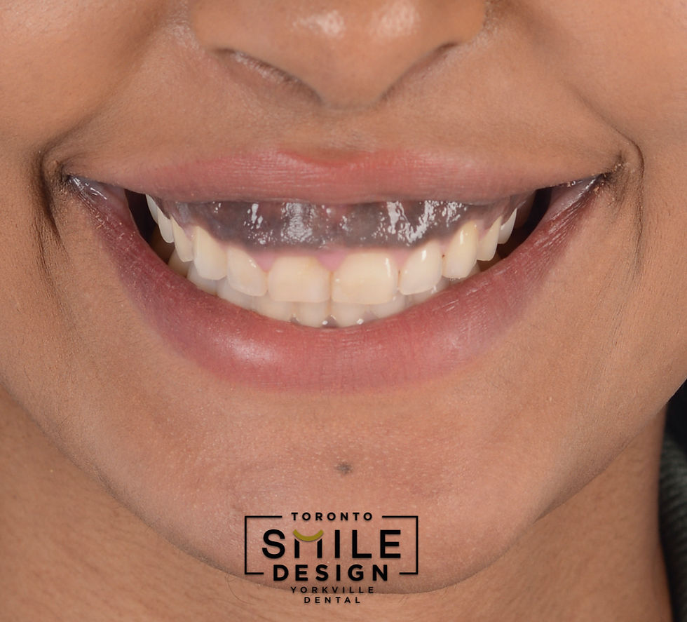 how to fix a gummy smile.001