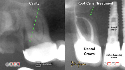 Root Canal - Tooth Pain.jpeg