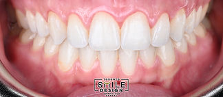 Laser Crown Lengthening in Toronto.009.jpeg