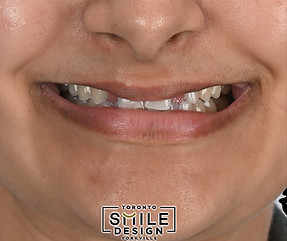 Before and after pictures of a missing lateral case with dental veneers and dental implant