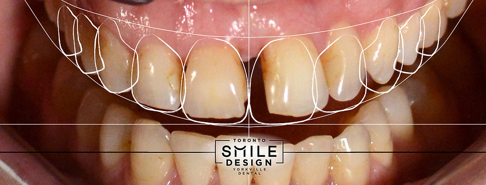 Frontal Smile Design picture of the Dental Veneer and Dental Crown Cosmetic Dentistry Patient