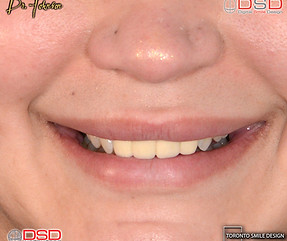Cosmetic Dentistry Toronto - Porcelain C