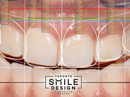 Crown Lengthening (Gum Contouring Procedure): A colossal necessity in The Smile Makeover