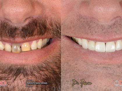 Teeth Gaps: Can they be closed without the use of braces?