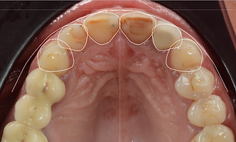 Digital Smile Design Smile Frame