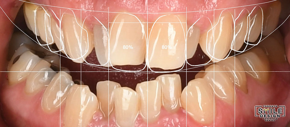 Two-dimensional Digital Smile Design planning with facial and dental reference lines, created as part of a complex Smile Makeover Toronto case at Toronto Smile Design – Yorkville Dental. This analysis allowed the cosmetic dentist Toronto team to evaluate symmetry, tooth proportions, smile arc, midline, and facial harmony before proceeding with advanced cosmetic dentistry treatment involving porcelain veneers Toronto and restorative smile design.
