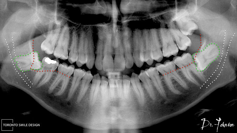 impacted wisdom teeth removal nerve damage - nerve damage after wisdom teeth removal.jpeg