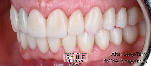 This left intraoral image shows the smile after long-term PMMA provisionals were inserted. Side views are essential because deep bite and bite collapse patterns often load unevenly, and we want to confirm improved contact balance from left to right. At our dental clinic Yorkville, these provisional-stage images help us evaluate occlusal plane stability, tooth display, and how the temporaries support tissue healing following crown lengthening with osteotomy when indicated. For patients searching full mouth reconstruction Toronto or an occlusion/bite correction dentist Toronto, this image demonstrates the provisional “test drive” phase—where we verify comfort and stability before final restorations are fabricated.