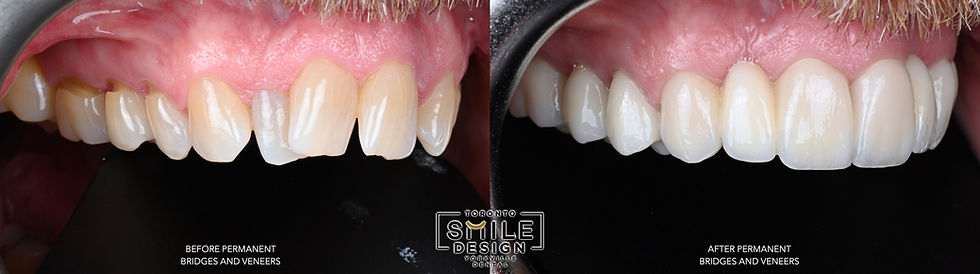 Before-and-after intraoral photographs from the centre, right, and left views showing the final Smile Makeover Toronto result after advanced Digital Smile Design at Toronto Smile Design – Yorkville Dental. These images highlight corrected crowded teeth, improved gumline symmetry, refined tooth proportions, and a more harmonious restorative outcome achieved through meticulous cosmetic dentistry planning and execution.