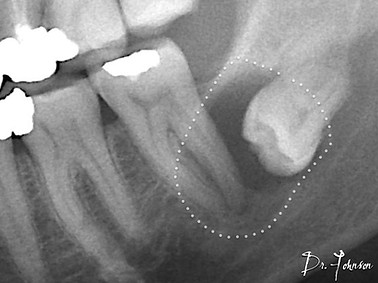 how long is wisdom teeth recovery - wisd