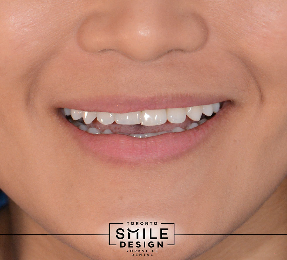 Dental Veneers for Smile Transformation