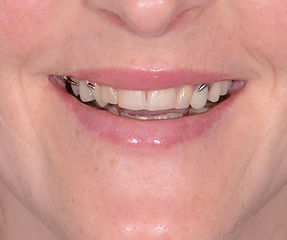 smile design toronto case - porcelain cr