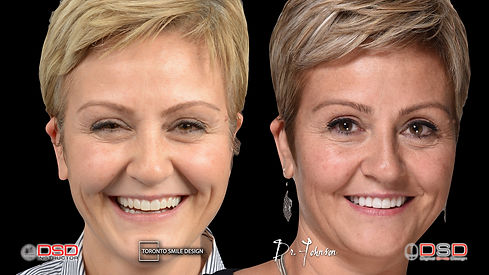 Smile Design - Digital Smile Design - Toronto Dentist.jpeg
