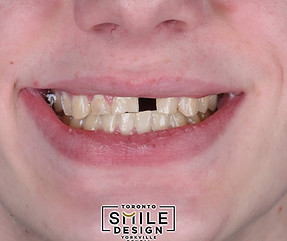 hockey teeth - missing tooth - dental bridge_edited.jpg