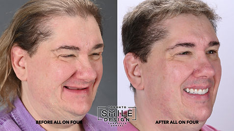Dental Face Lift Case in Toronto