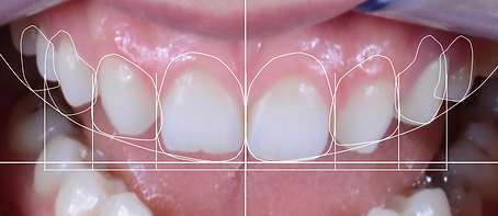Digital Smile Design Smile Frame