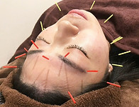 美容針_女性ほほえみ.jpg