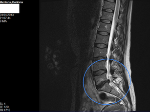 Diagnose Bandscheibenvorfall und Osteochondrose L5/S1