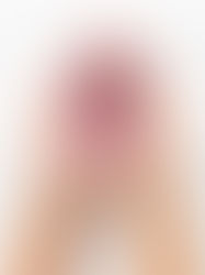 The Many Faces of Lupus: How One Disease Can Affect the Skin - and the Mind