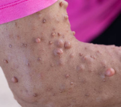 Neurofibromatosis Type 1: The Reality Behind the Diagnosis