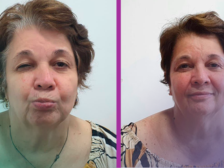Paralisia facial: o que sabemos sobre ela?