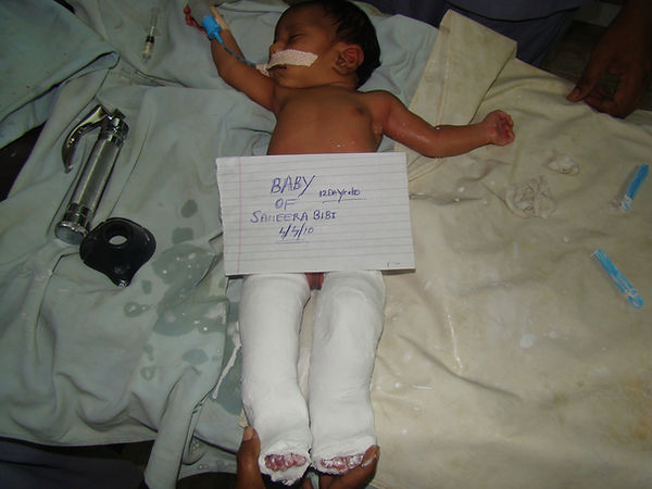 manipulation of harmonal joint instabilities soon after birth -a corrected disability