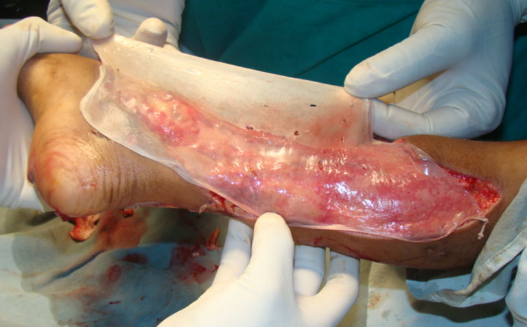 KOWS -surgeries for skin cover with a collagen sheet .