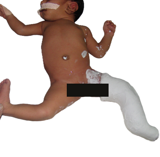 manipulation of harmonal joint instabilities soon after birth -a correctable disability