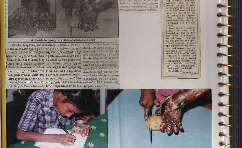A recovered post compartmental syndrome