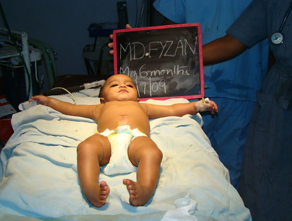 KOWS - a baby with CTEV before surgical correction