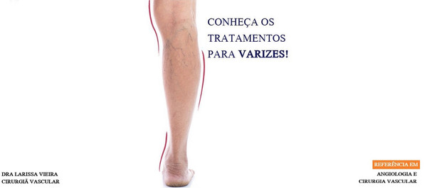 TratamentosVarizes.jpg