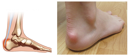Retrocalcaneal bursa.png