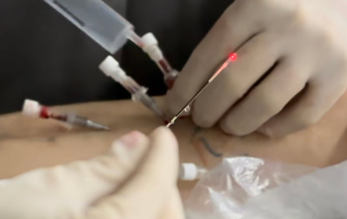 Laser Endovenoso técnica ATTA