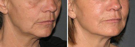 fillers levres chateauguay