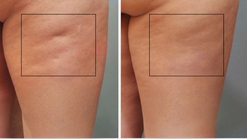 cellulite soins chateauguay
