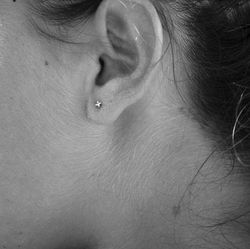 Oreille illustrant les zones réflexes utilisées en auriculomédecine