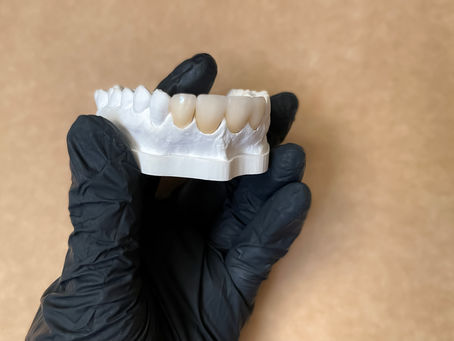 La Revolución en el Diseño Dental: La Importancia de Elegir Materiales Seguros y Duraderos (Carillas Porcelana)
