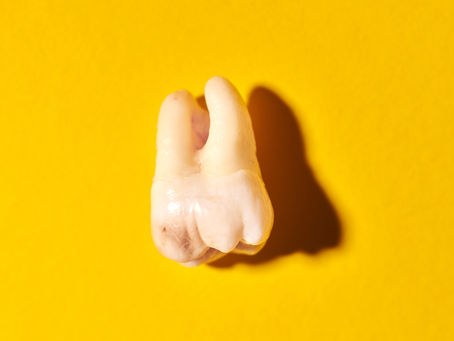 Terceros Molares o Muelas del Juicio: ¿Amigas o enemigas? Terceros molares Santo Domingo Muelas del juicio