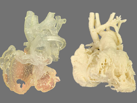 Simulación a medida en cirugía pediátrica: Drenaje venoso pulmonar anómalo