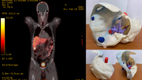 Modelización e impresión 3D para cirugía hepática compleja