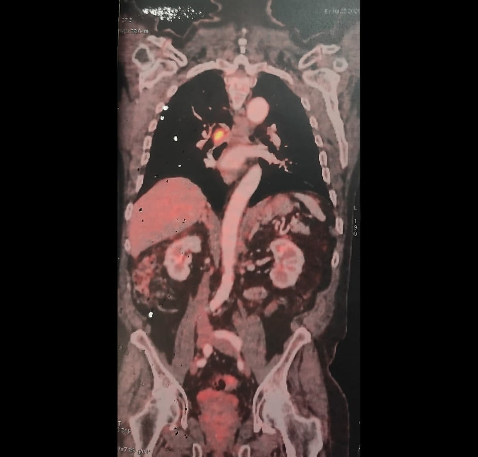 PET - CT. Vista Coronal